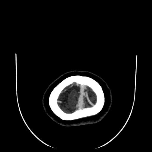 Cavernoma with developmental venous anomaly (Radiopaedia 22470-22506 C 196).jpg