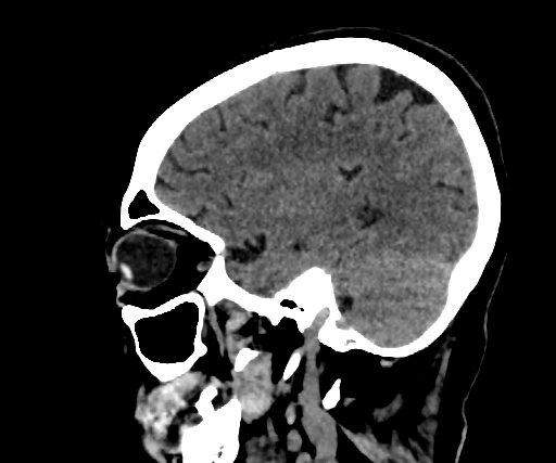 Cavernous hemangioma of the cerebellar falx (Radiopaedia 73025-83723 B 234).jpg