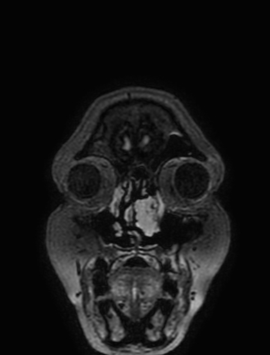 Cavernous hemangioma of the cerebellar falx (Radiopaedia 73025-83724 Coronal FLAIR 11).jpg