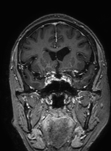 Cavernous hemangioma of the cerebellar falx (Radiopaedia 73025-83724 Coronal T1 C+ 136).jpg