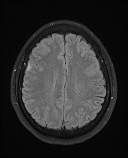 File:Cavernous sinus meningioma (Radiopaedia 63682-72367 Axial FLAIR 16).jpg