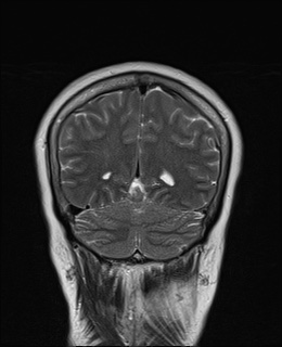 File:Cavernous sinus meningioma (Radiopaedia 63682-72367 Coronal T2 17).jpg