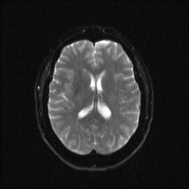 Cavernous sinus meningioma (Radiopaedia 63682-72367 DWI 14).jpg