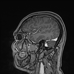 Cavernous sinus meningioma (Radiopaedia 63682-72367 Sagittal T1 C+ 50).jpg