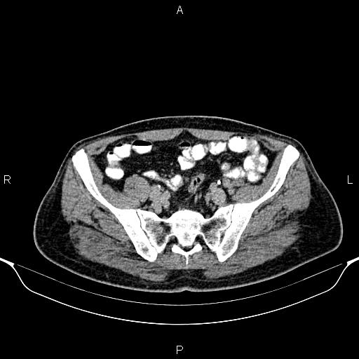 Cecal adenocarcinoma (Radiopaedia 85324-100916 Axial C+ delayed 76).jpg