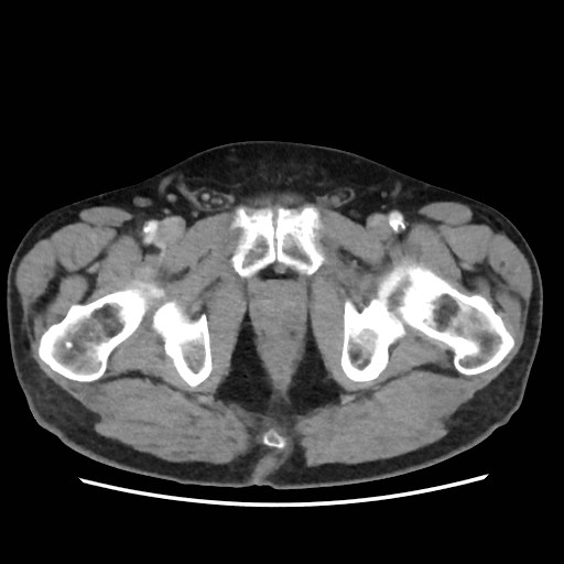 Cecal mass causing appendicitis (Radiopaedia 59207-66531 A 89).jpg