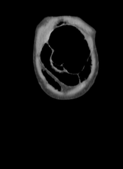 Cecal volvulus with pneumatosis coli (Radiopaedia 68572-78178 B 70).jpg