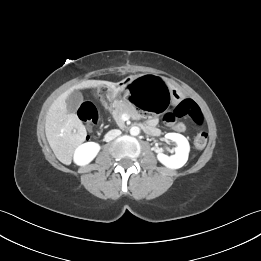 Cecum hernia through the foramen of Winslow (Radiopaedia 46634-51112 A 32).png