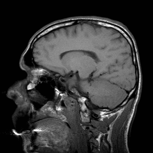 File:Central-variant posterior reversible encephalopathy syndrome (PRES) (Radiopaedia 43880-47358 Sagittal T1 9).jpg