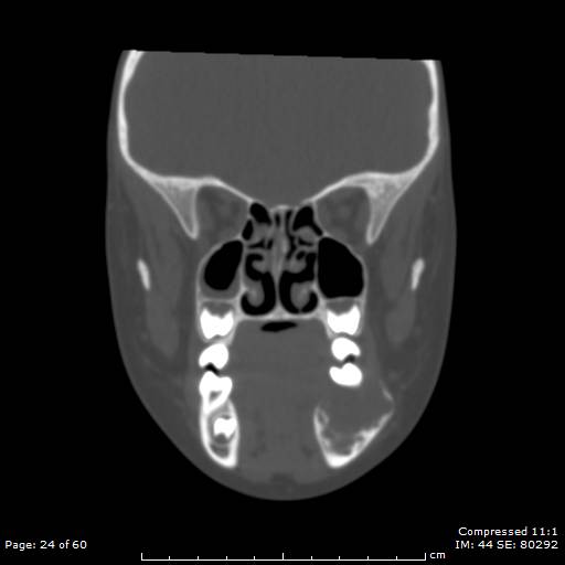 File:Central giant cell granuloma (Radiopaedia 45612-49754 Coronal bone window 24).jpg