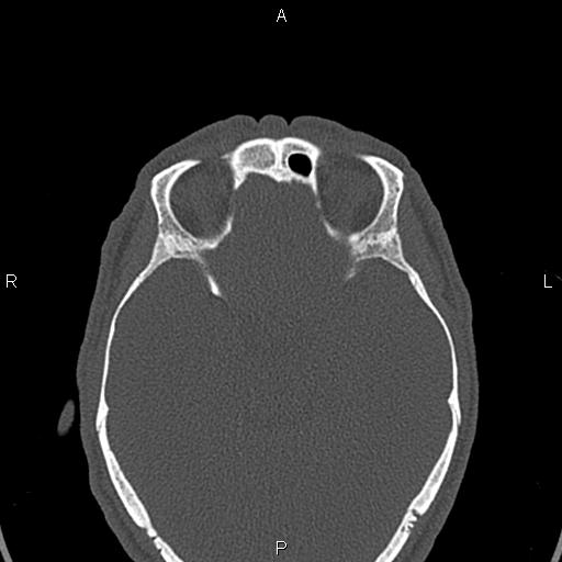 File:Central giant cell granuloma (Radiopaedia 83346-97761 Axial bone window 68).jpg