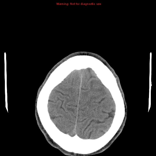 File:Central nervous system vasculitis (Radiopaedia 8410-9234 Axial non-contrast 24).jpg