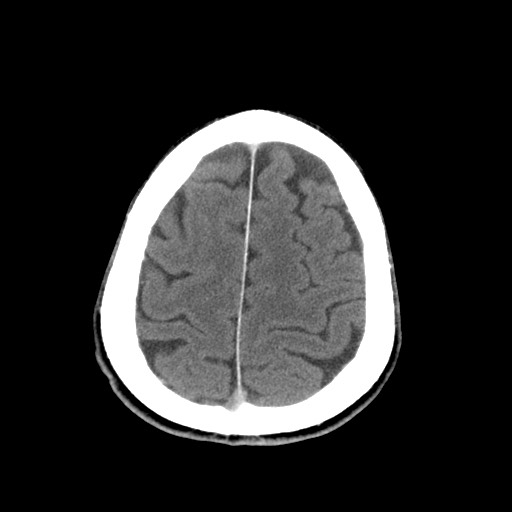 File:Central neurocytoma (Radiopaedia 68725-78432 Axial C+ 80).jpg