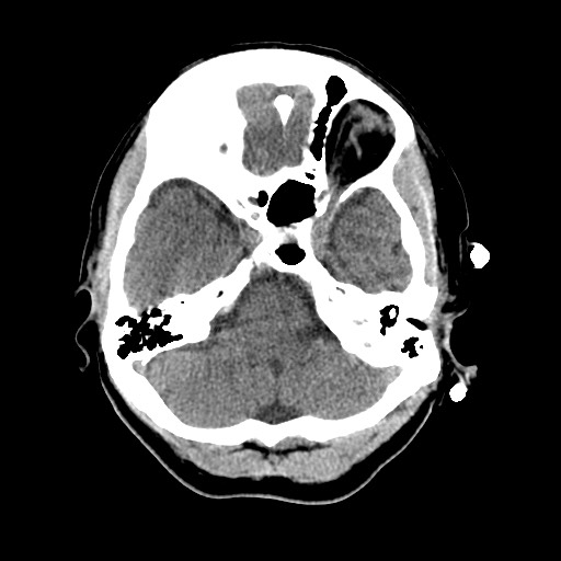 File:Central neurocytoma (Radiopaedia 68725-78432 Axial non-contrast 11).jpg