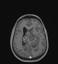Central neurocytoma (Radiopaedia 84497-99872 Axial T1 C+ 100).jpg