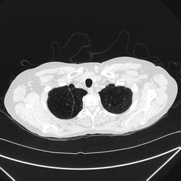 Centrilobular pulmonary emphysema (Radiopaedia 24495-24789 Axial lung window 8).jpg