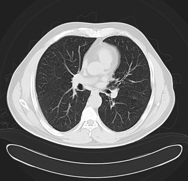 Centrilobular pulmonary emphysema (Radiopaedia 26808-26971 C 23).jpg