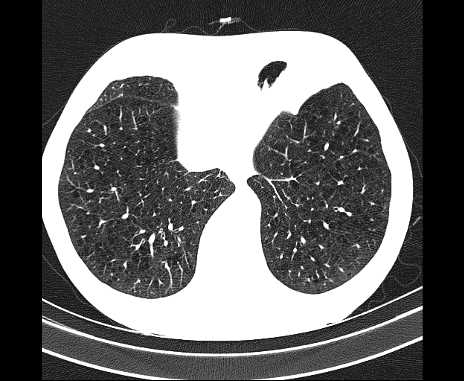 Centrilobular pulmonary emphysema (Radiopaedia 62468-70718 Axial lung window 62).jpg