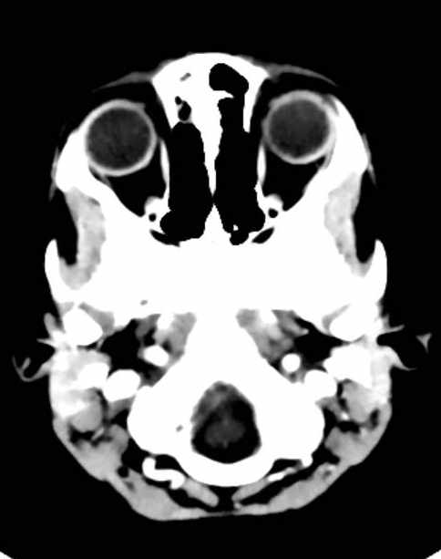 Cerebellar abscess (Radiopaedia 73727-84527 Axial C+ 6).jpg