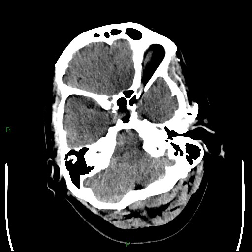 Cerebellar abscess (Radiopaedia 78135-90671 Axial non-contrast 25).jpg