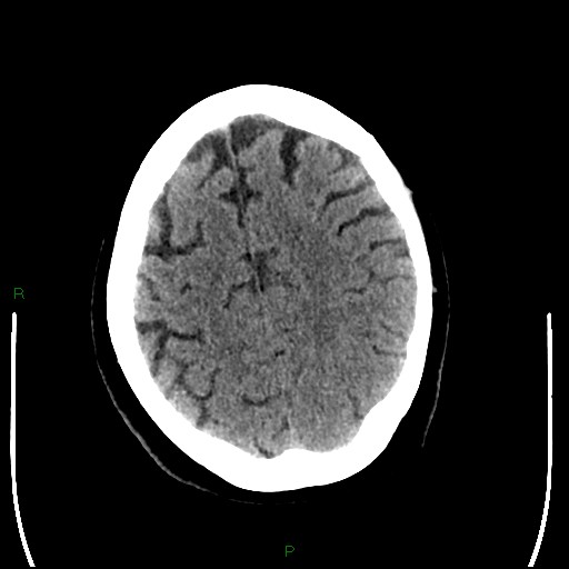 Cerebellar abscess (Radiopaedia 78135-90671 Axial non-contrast 84).jpg
