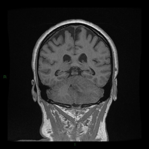 Cerebellar abscess (Radiopaedia 78135-90678 Coronal T1 C+ 106).jpg