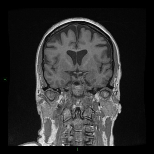 Cerebellar abscess (Radiopaedia 78135-90678 Coronal T1 C+ 69).jpg
