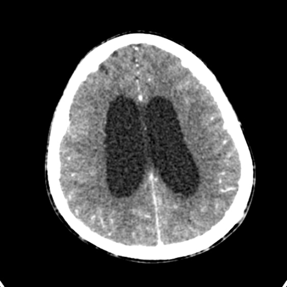 Cerebellar abscess secondary to mastoiditis (Radiopaedia 26284-26412 Axial C+ delayed 109).jpg