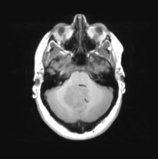 File:Cerebellar ependymoma complicated by post-operative subdural hematoma (Radiopaedia 83322-97736 Axial T1 12).png