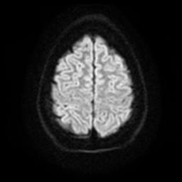 Cerebellar hemangioblastoma (Radiopaedia 29570-30077 Axial DWI 22).jpg
