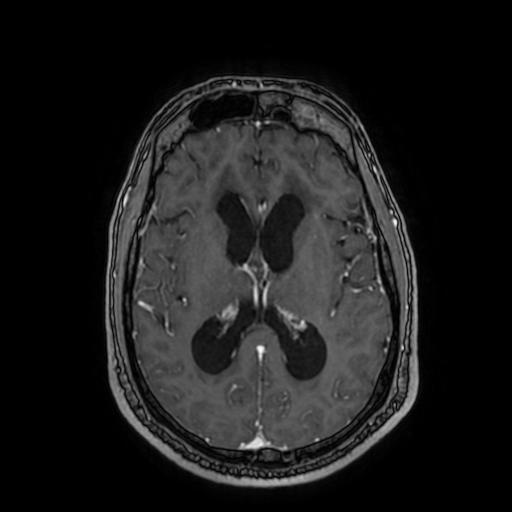 Cerebellar hemangioblastoma (Radiopaedia 88055-104622 Axial T1 C+ 101).jpg
