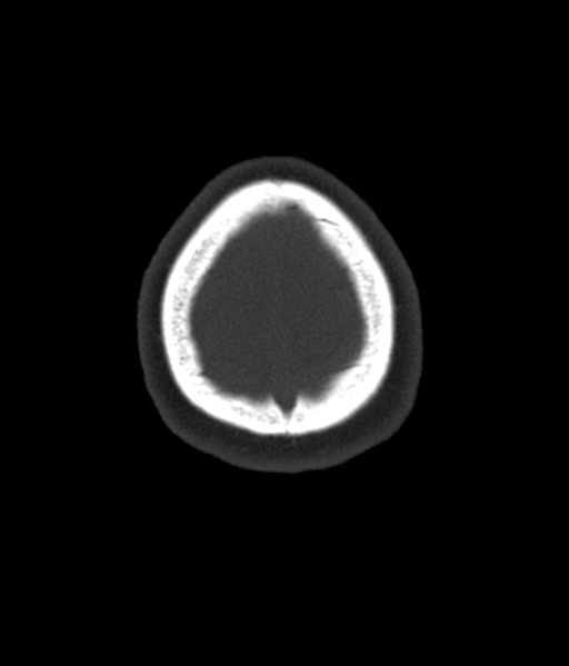 Cerebellar metastases - colorectal adenocarcinoma (Radiopaedia 40947-43652 AX Bone C- 2.0 MPR 62).png