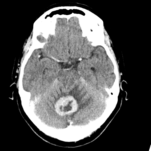Cerebellar metastasis (Radiopaedia 54578-60812 Axial C+ 17).png