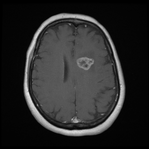 File:Cerebellar metastasis (cystic appearance) (Radiopaedia 41395-44268 Axial T1 C+ 16).png