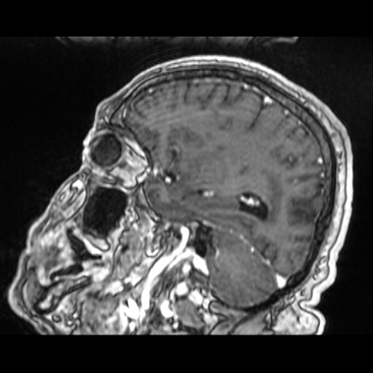 Cerebellar metastasis of pulmonary adenocarcinoma, cavernous venous malformation, and developmental venous anomaly (Radiopaedia 85827-101661 Sagittal T1 C+ 65).jpg