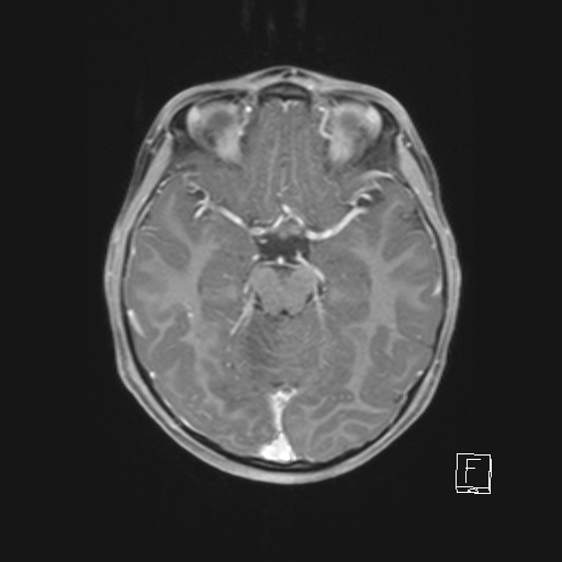 Cerebellar stroke (Radiopaedia 32202-33150 Axial T1 C+ 33).png