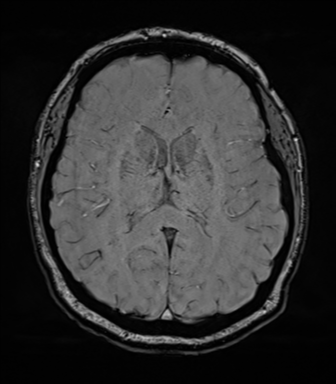 Cerebellopontine angle meningioma (Radiopaedia 48434-53348 Axial SWI 53).png