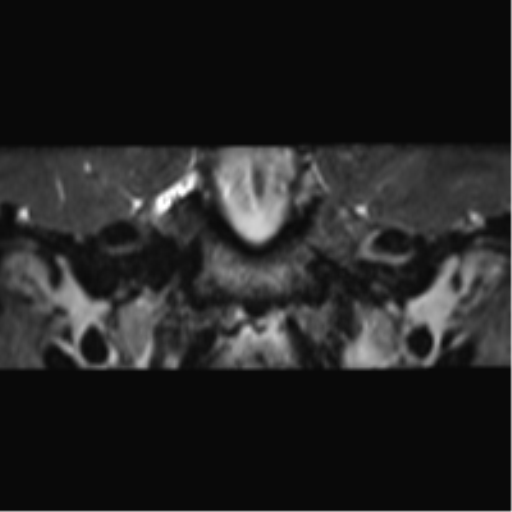 Cerebellopontine angle meningioma (Radiopaedia 48434-53348 Coronal T2 62).png