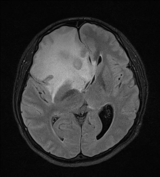 File:Cerebral abscess (Radiopaedia 24212-24478 Axial FLAIR 13).jpg