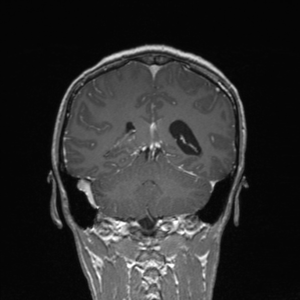 Cerebral abscess (Radiopaedia 24212-24478 Coronal T1 C+ 141).jpg