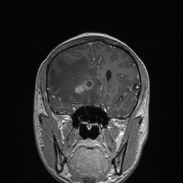 File:Cerebral abscess (Radiopaedia 24212-24478 Coronal T1 C+ 82).jpg