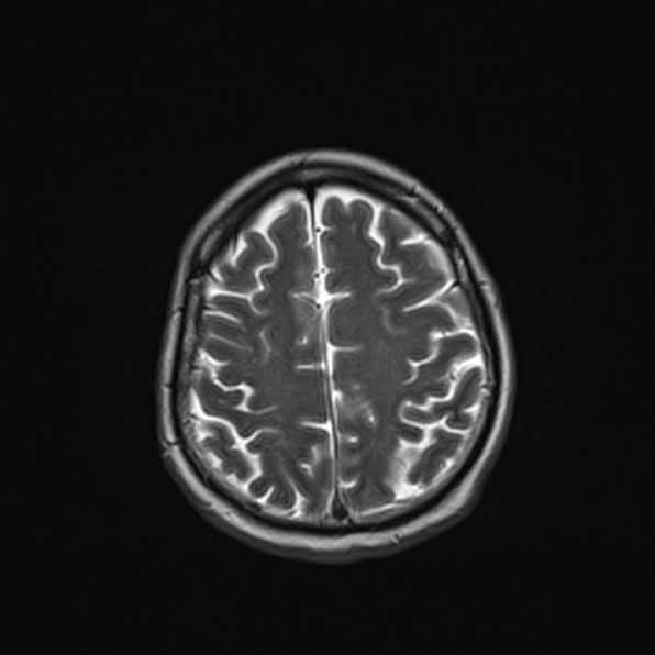 Cerebral abscess (Radiopaedia 26111-26247 Axial T2 47).jpg
