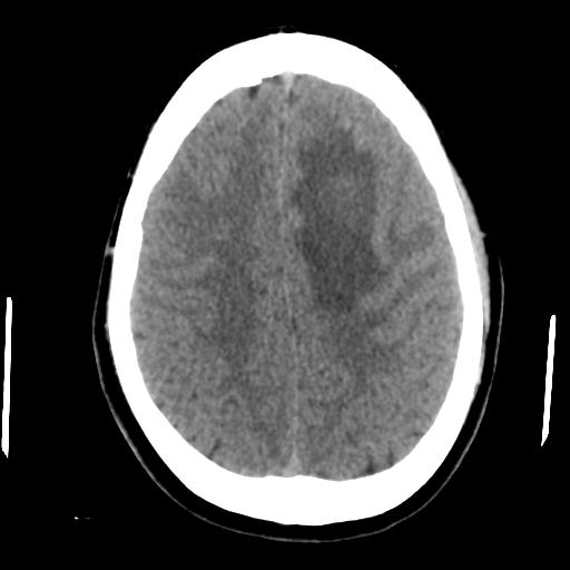 Cerebral abscess (Radiopaedia 29451-29919 Axial non-contrast 37).jpg