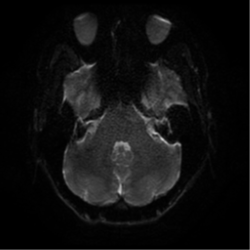 Cerebral abscess (Radiopaedia 57774-64740 Axial DWI 35).png