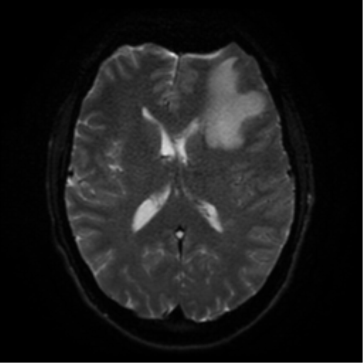 Cerebral abscess (Radiopaedia 57774-64740 Axial DWI 45).png