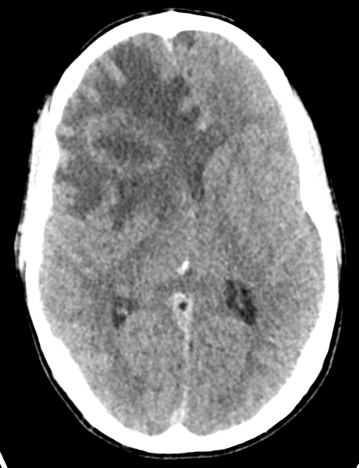 Cerebral abscess (Radiopaedia 60342-68008 Axial non-contrast 27).png