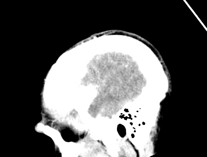 File:Cerebral abscess (Radiopaedia 60342-68008 Sagittal C+ delayed 45).png