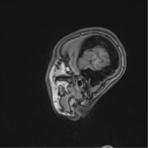 Cerebral abscess (Radiopaedia 60342-68009 Sagittal T1 9).png