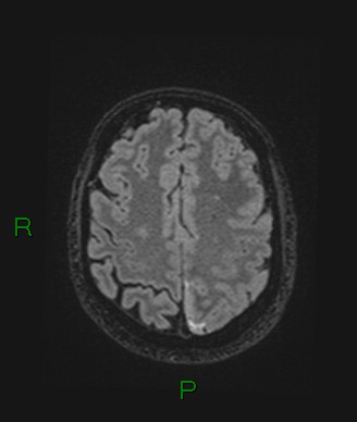 Cerebral abscess and subdural empyema (Radiopaedia 84436-99779 Axial FLAIR 25).jpg