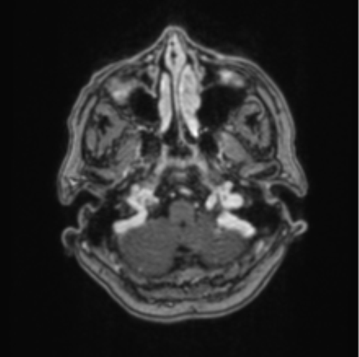 Cerebral abscess from pulmonary arteriovenous malformation (Radiopaedia 86275-102291 Axial T1 C+ 14).png